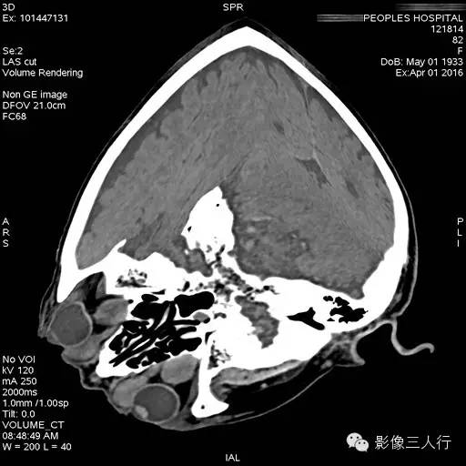 【病例】双侧永存副眼1例CT 【病例】双侧永存副眼1例CT
