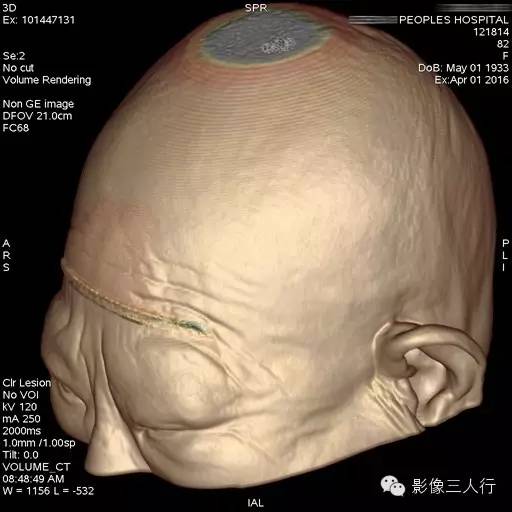【病例】双侧永存副眼1例CT 【病例】双侧永存副眼1例CT