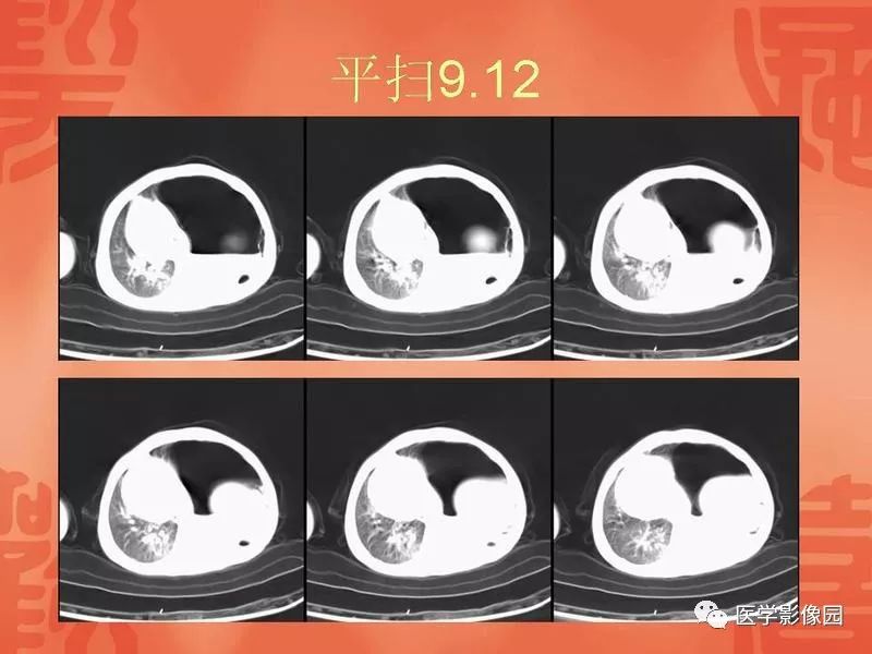 【病例】儿童肺母细胞瘤1例CT影像表现