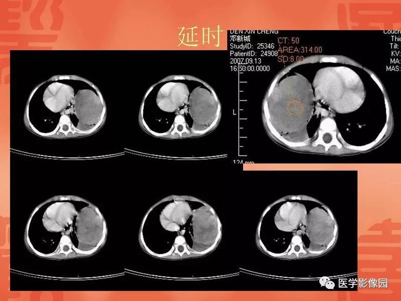 【病例】儿童肺母细胞瘤1例CT影像表现
