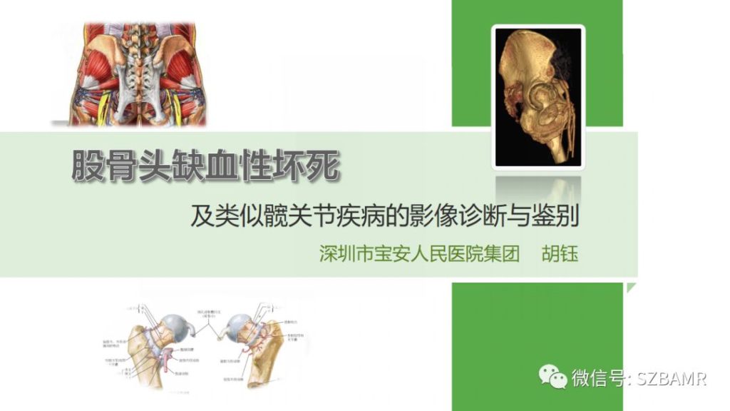 【PPT】股骨头缺血性坏死及类似髋关节疾病的影像诊断与鉴别