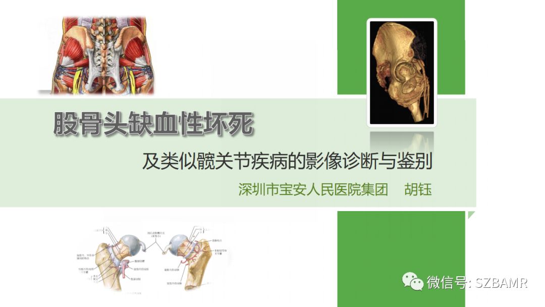 【PPT】股骨头缺血性坏死及类似髋关节疾病的影像诊断与鉴别