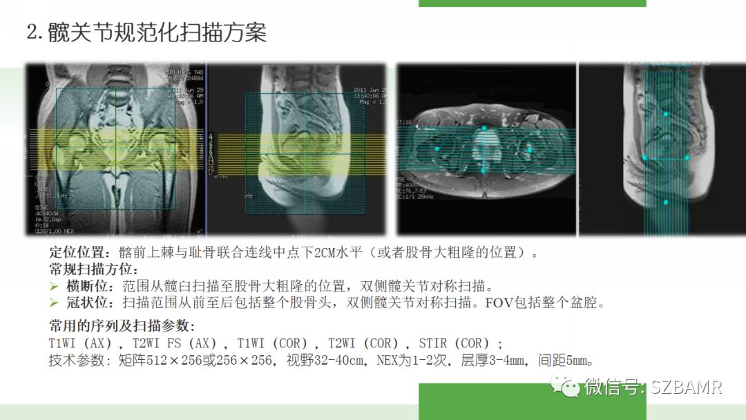 【PPT】股骨头缺血性坏死及类似髋关节疾病的影像诊断与鉴别