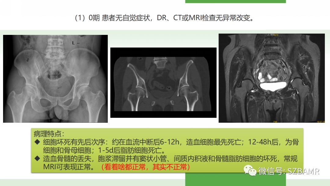 【PPT】股骨头缺血性坏死及类似髋关节疾病的影像诊断与鉴别