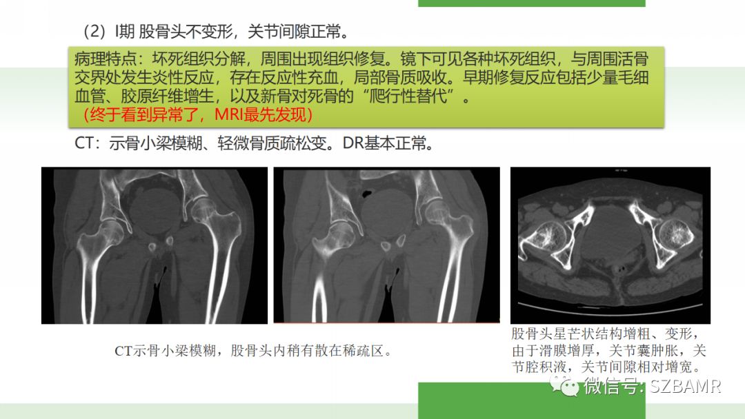 【PPT】股骨头缺血性坏死及类似髋关节疾病的影像诊断与鉴别