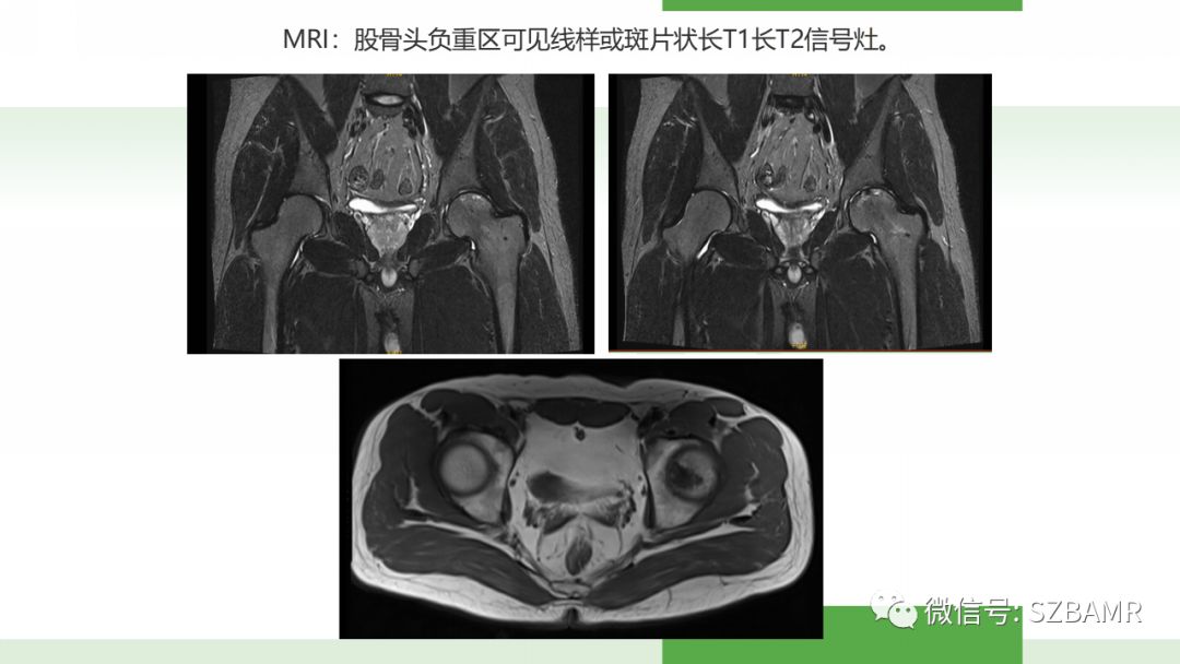 【PPT】股骨头缺血性坏死及类似髋关节疾病的影像诊断与鉴别