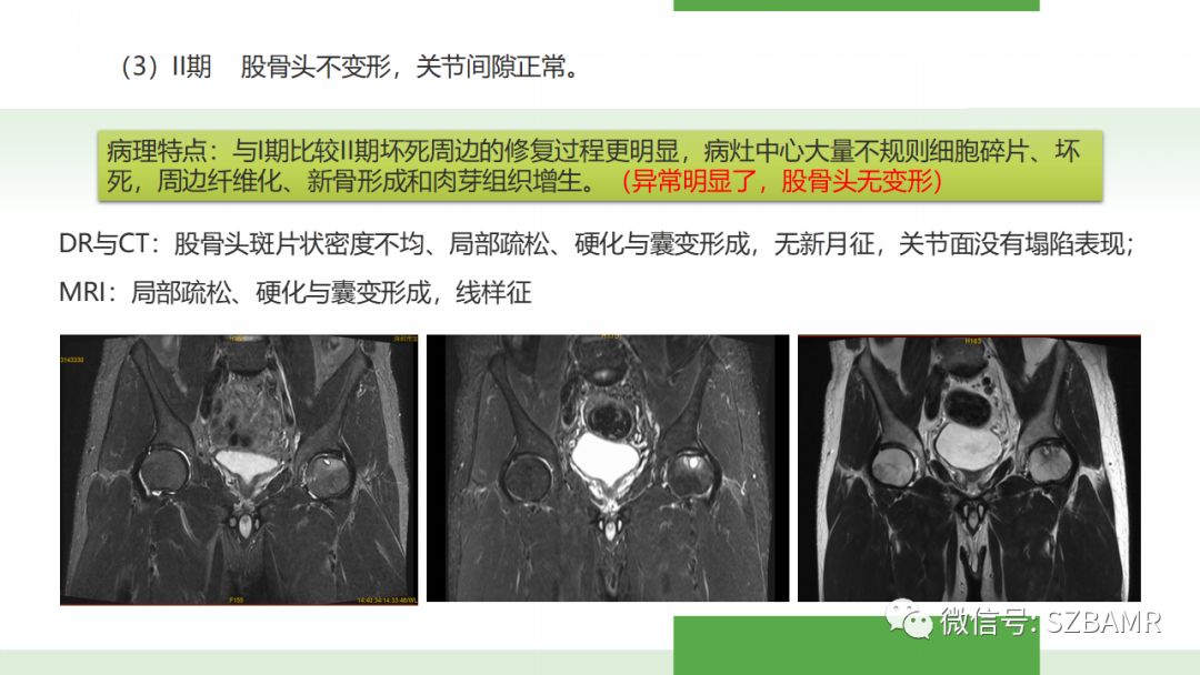 【PPT】股骨头缺血性坏死及类似髋关节疾病的影像诊断与鉴别