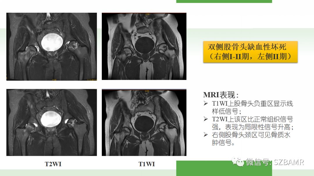 【PPT】股骨头缺血性坏死及类似髋关节疾病的影像诊断与鉴别