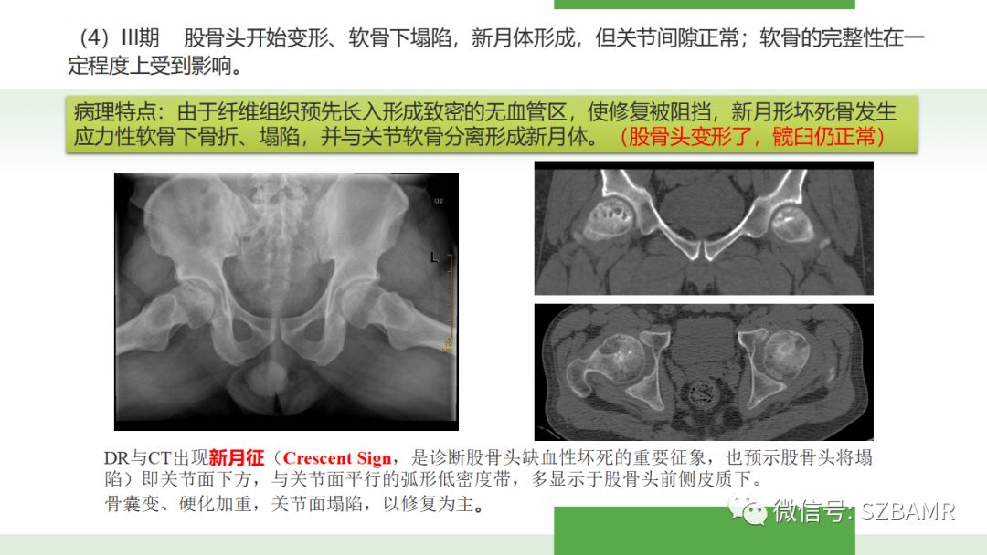 【PPT】股骨头缺血性坏死及类似髋关节疾病的影像诊断与鉴别