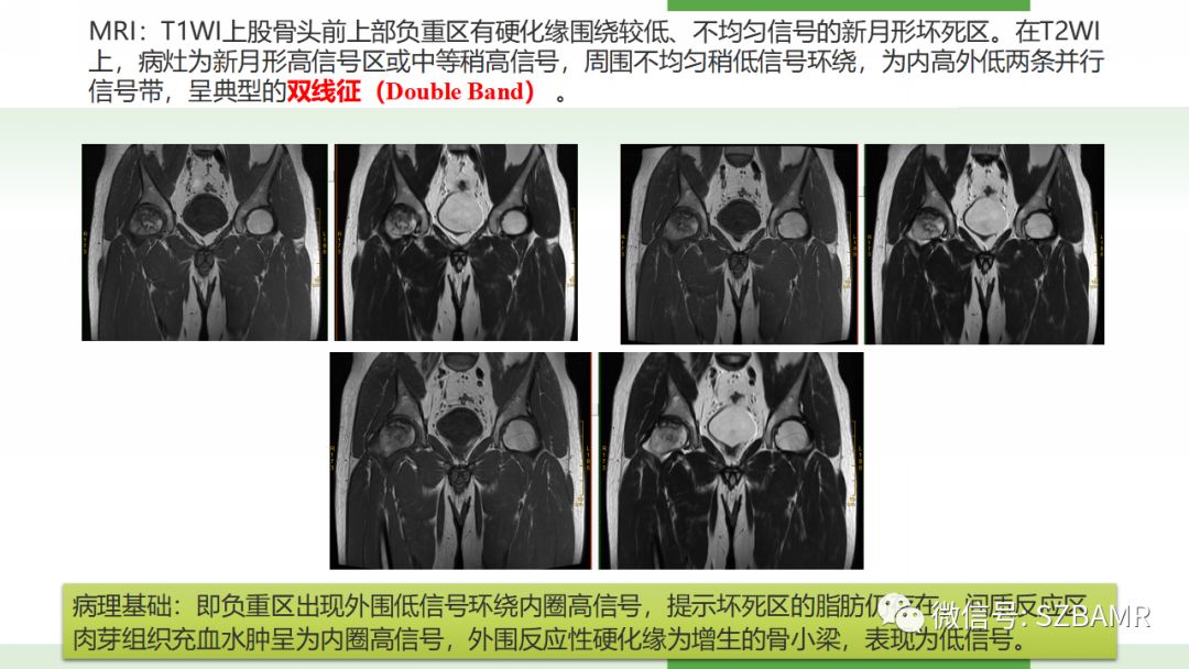 【PPT】股骨头缺血性坏死及类似髋关节疾病的影像诊断与鉴别