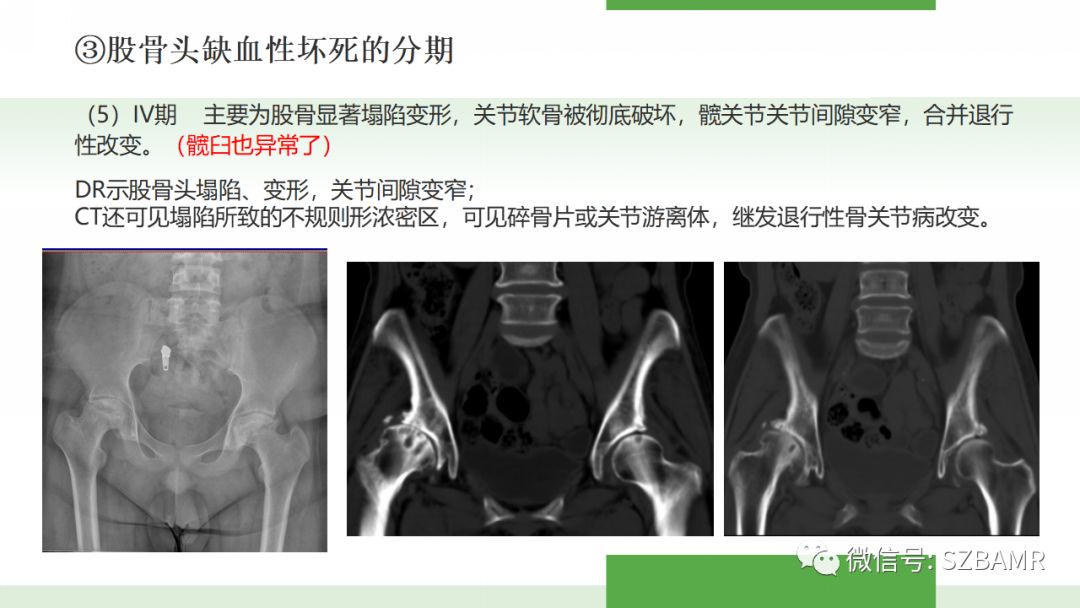 【PPT】股骨头缺血性坏死及类似髋关节疾病的影像诊断与鉴别