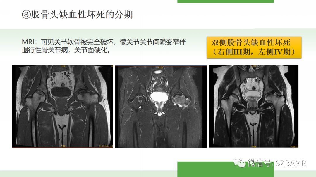 【PPT】股骨头缺血性坏死及类似髋关节疾病的影像诊断与鉴别