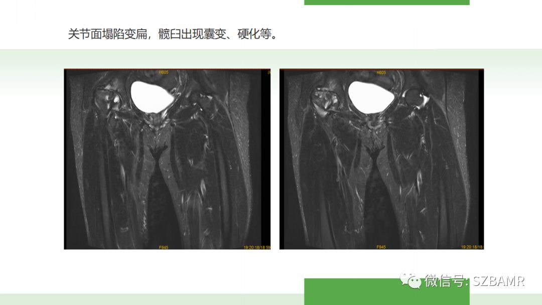 【PPT】股骨头缺血性坏死及类似髋关节疾病的影像诊断与鉴别