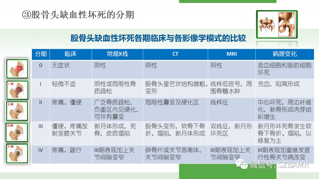 【PPT】股骨头缺血性坏死及类似髋关节疾病的影像诊断与鉴别