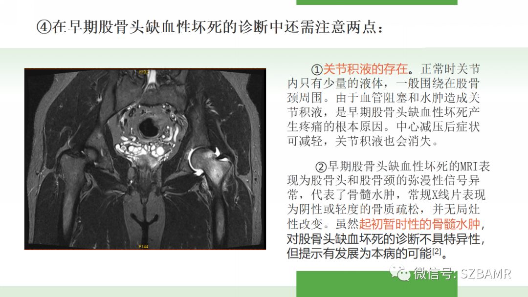 【PPT】股骨头缺血性坏死及类似髋关节疾病的影像诊断与鉴别