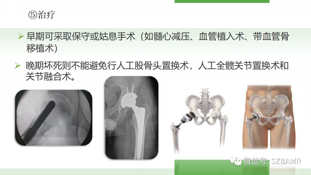 【PPT】股骨头缺血性坏死及类似髋关节疾病的影像诊断与鉴别