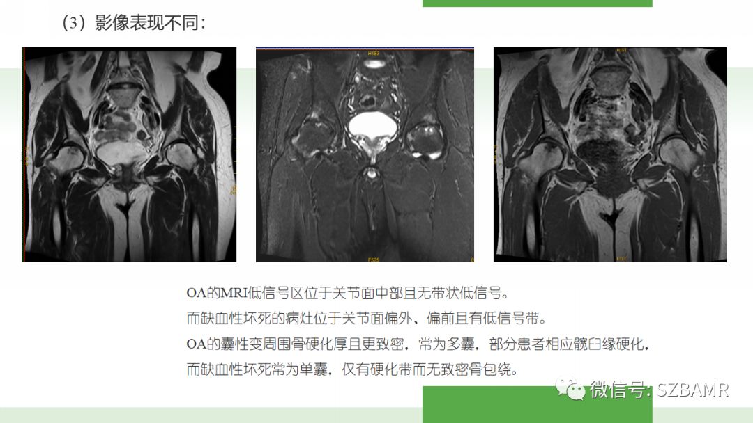 【PPT】股骨头缺血性坏死及类似髋关节疾病的影像诊断与鉴别