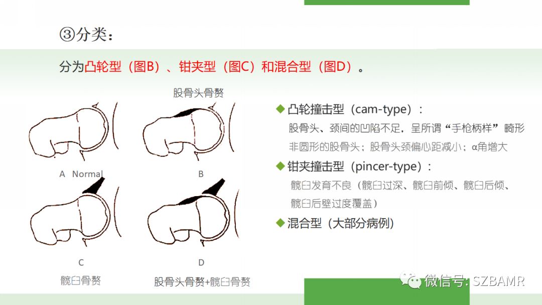 【PPT】股骨头缺血性坏死及类似髋关节疾病的影像诊断与鉴别