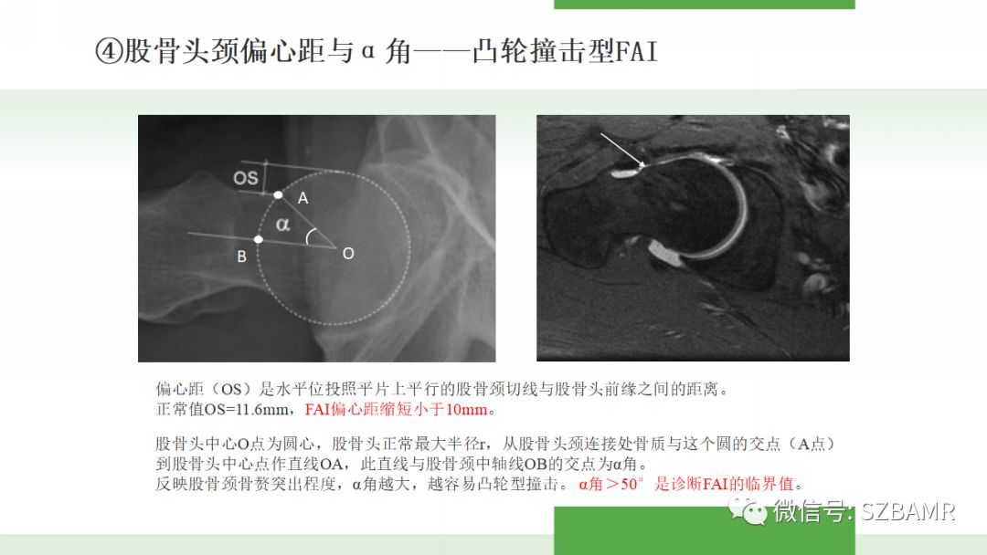 【PPT】股骨头缺血性坏死及类似髋关节疾病的影像诊断与鉴别
