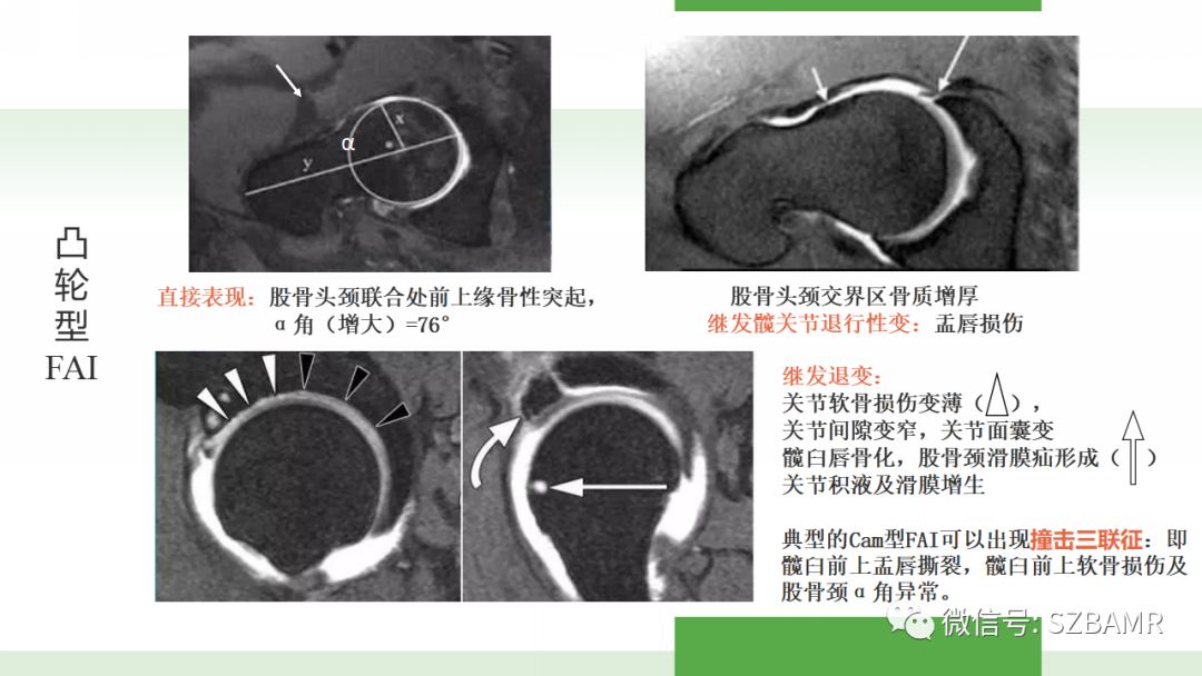 【PPT】股骨头缺血性坏死及类似髋关节疾病的影像诊断与鉴别