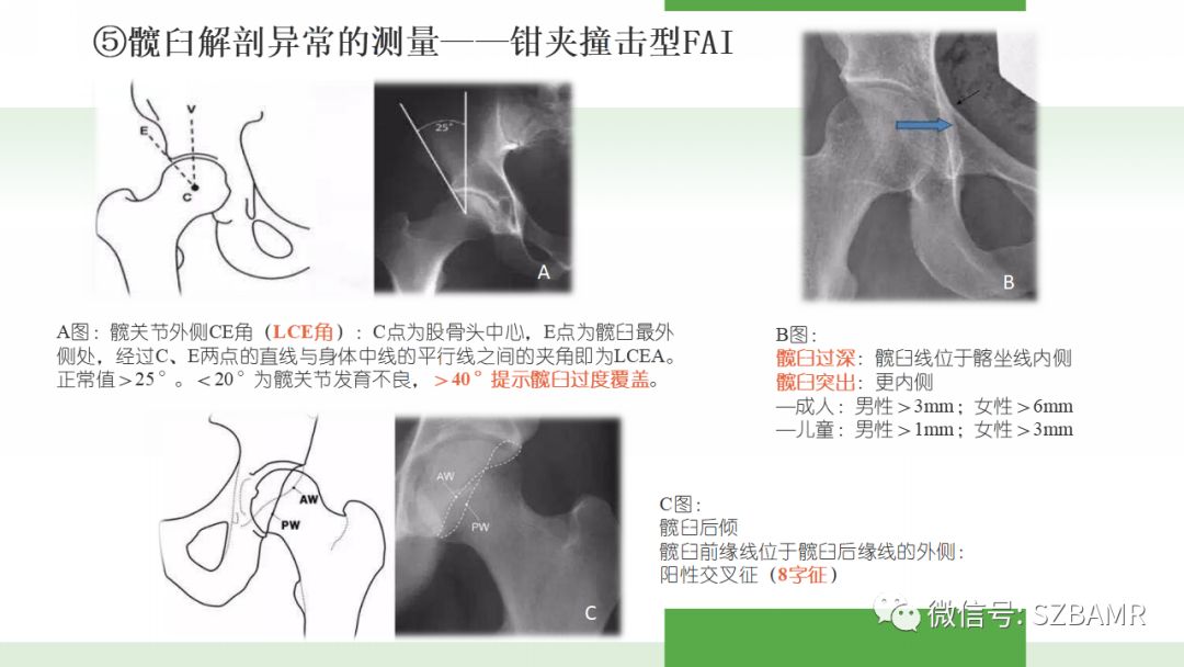 【PPT】股骨头缺血性坏死及类似髋关节疾病的影像诊断与鉴别