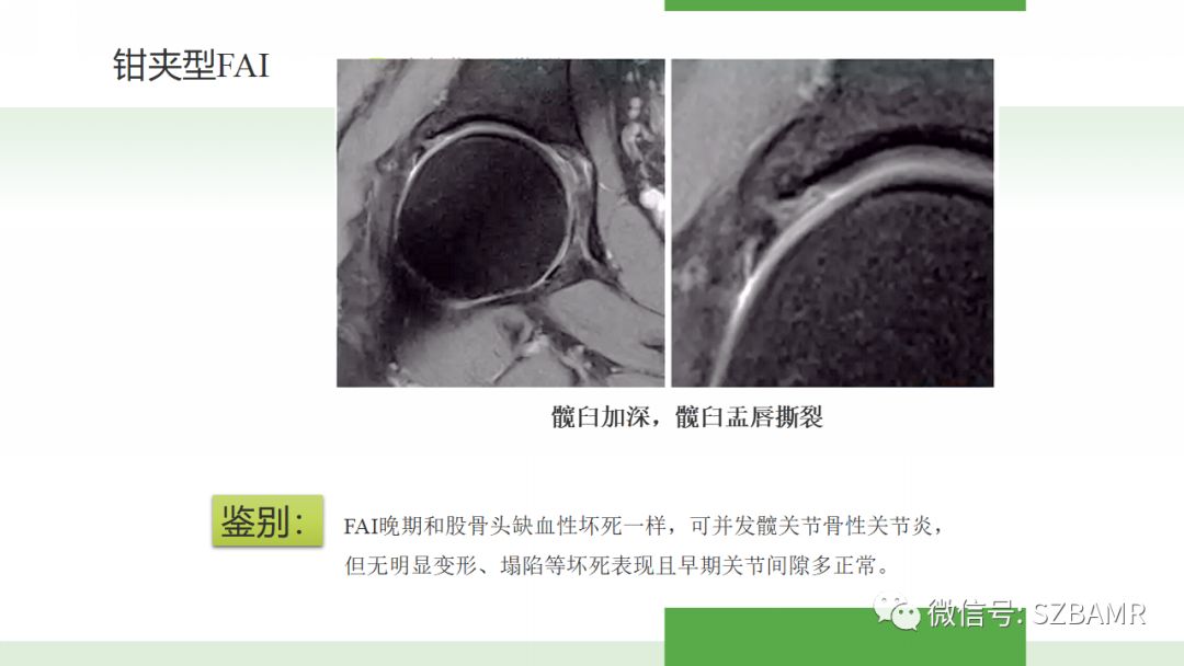 【PPT】股骨头缺血性坏死及类似髋关节疾病的影像诊断与鉴别