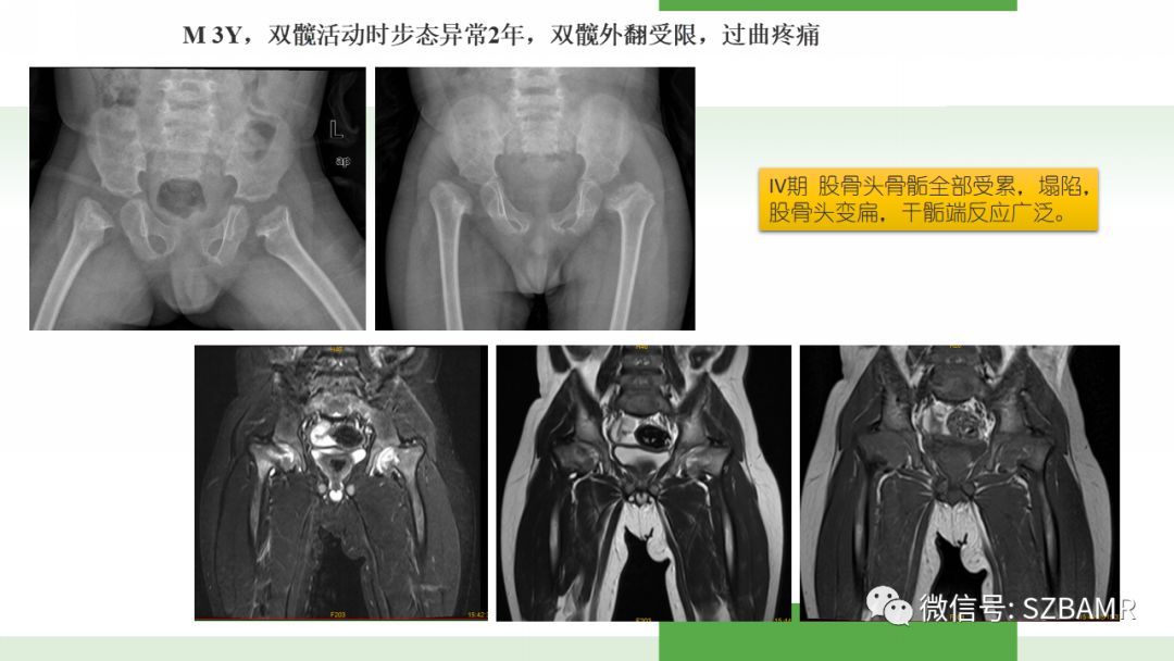 【PPT】股骨头缺血性坏死及类似髋关节疾病的影像诊断与鉴别