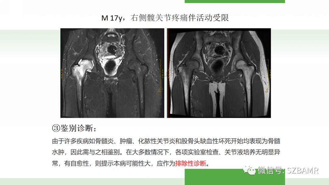 【PPT】股骨头缺血性坏死及类似髋关节疾病的影像诊断与鉴别