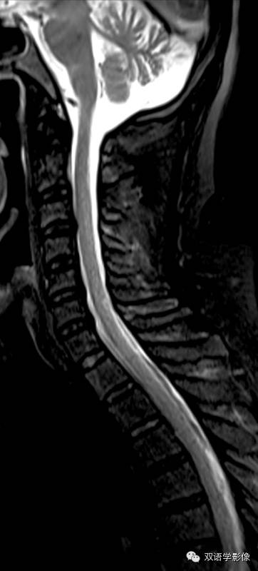 【双语病例】Subacute Combined Degeneration脊髓亚急性联合变性