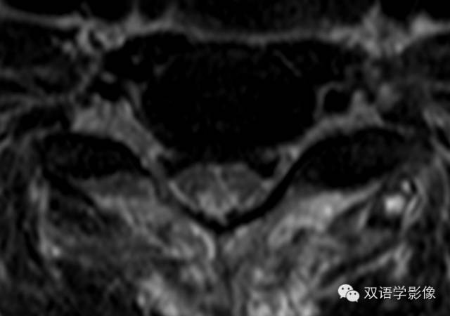 【双语病例】Subacute Combined Degeneration脊髓亚急性联合变性