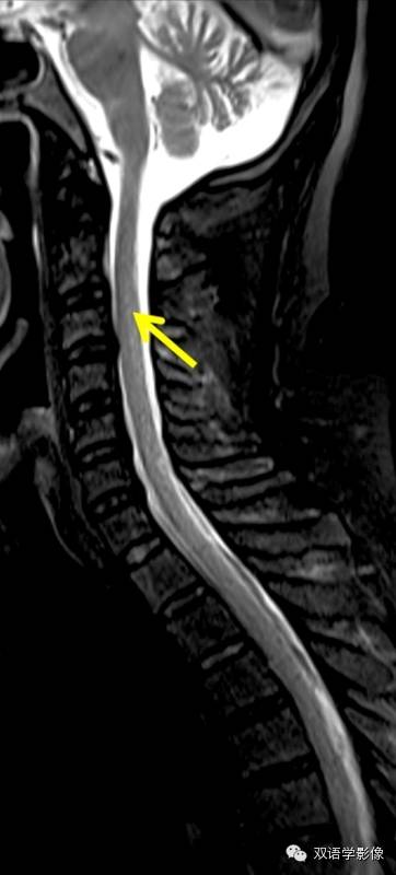 【双语病例】Subacute Combined Degeneration脊髓亚急性联合变性