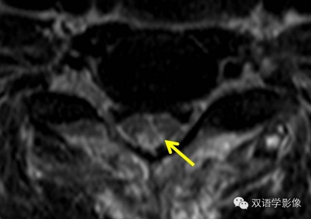 【双语病例】Subacute Combined Degeneration脊髓亚急性联合变性