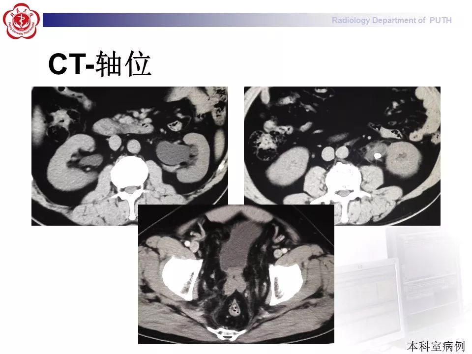 【病例】盆腔脂肪增多症1例CT影像表现