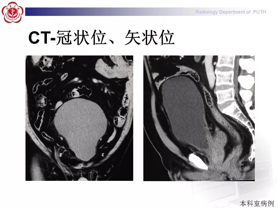 【病例】盆腔脂肪增多症1例CT影像表现