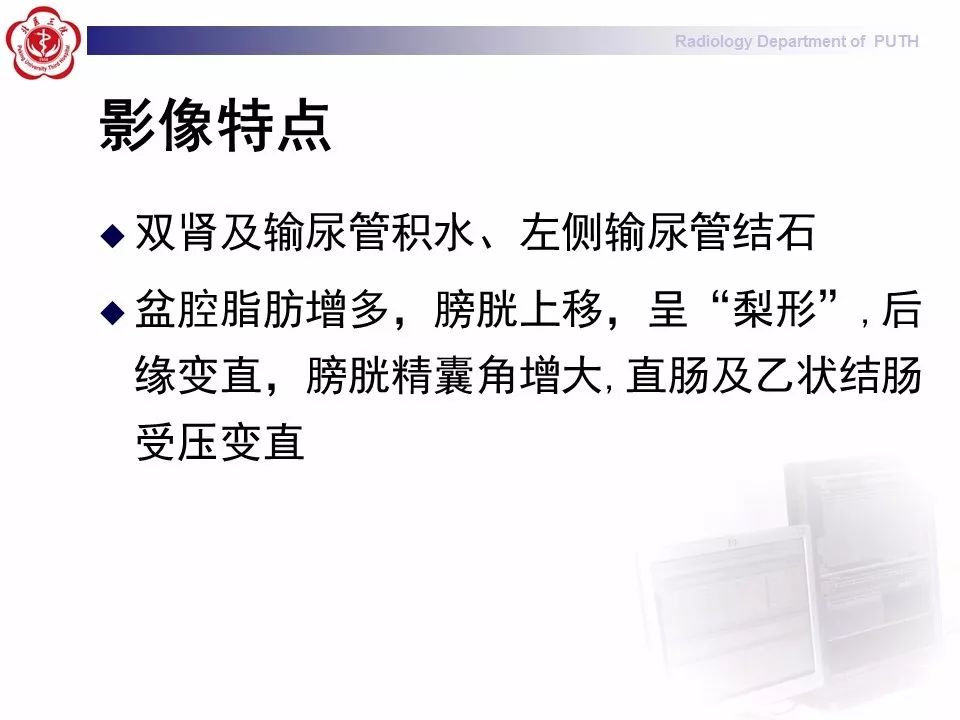【病例】盆腔脂肪增多症1例CT影像表现