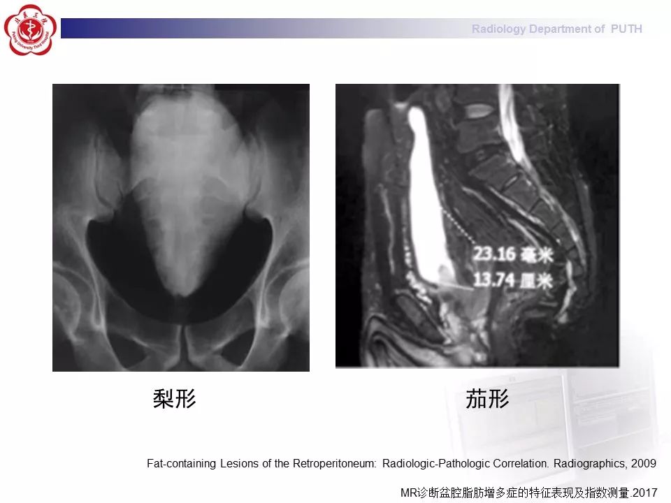 【病例】盆腔脂肪增多症1例CT影像表现