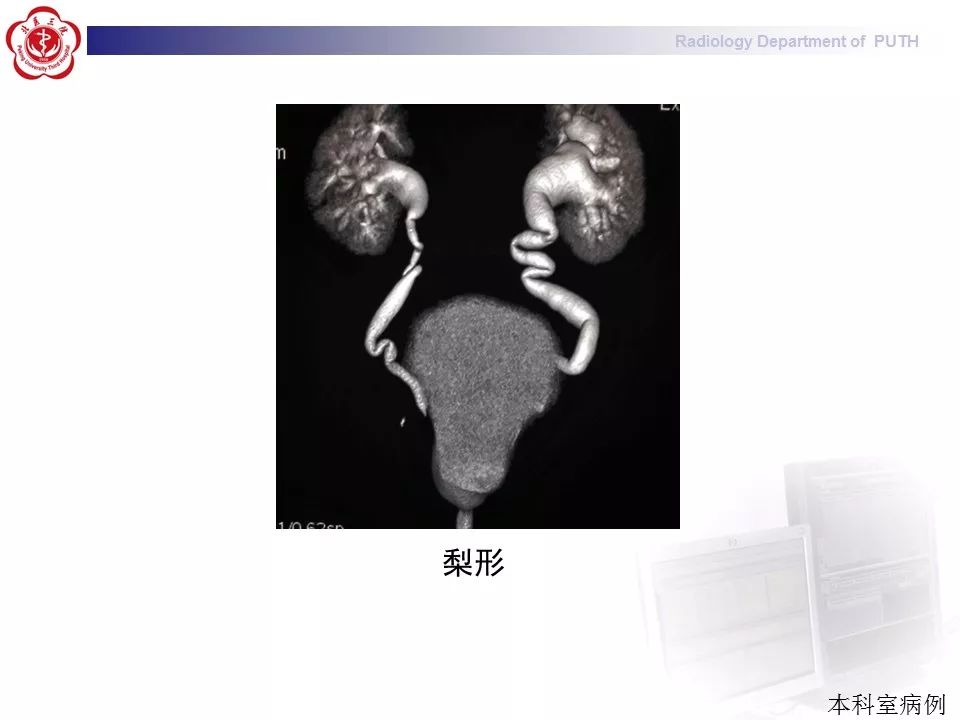 【病例】盆腔脂肪增多症1例CT影像表现