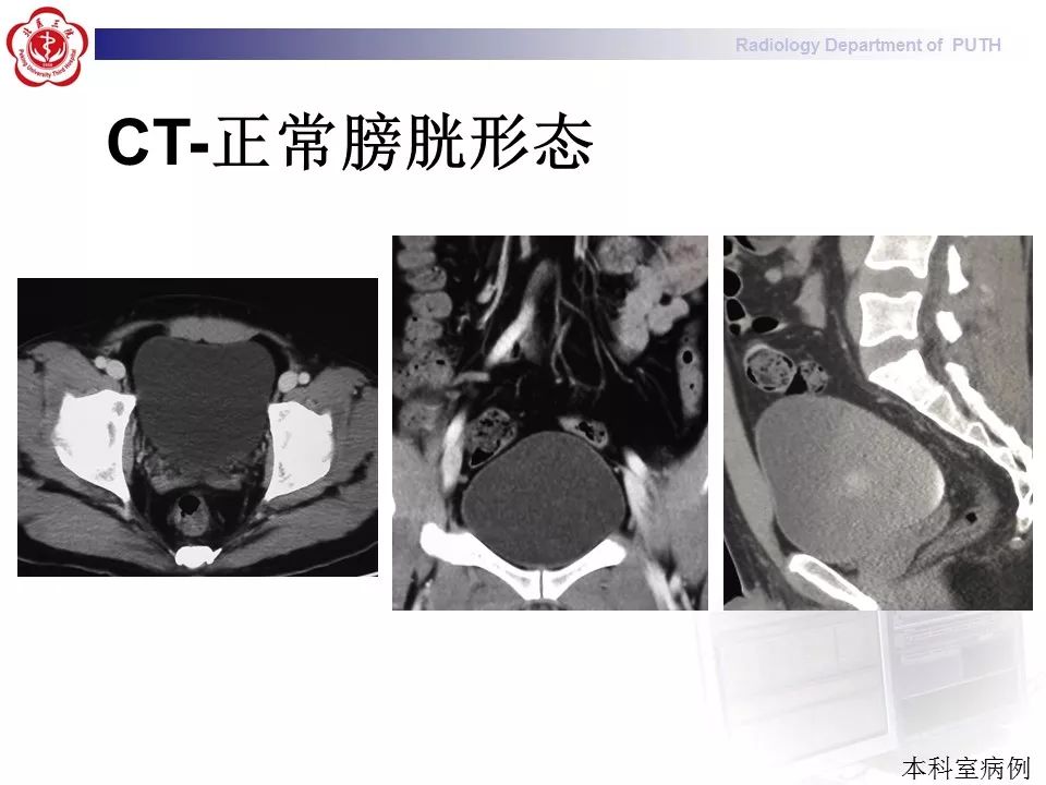【病例】盆腔脂肪增多症1例CT影像表现