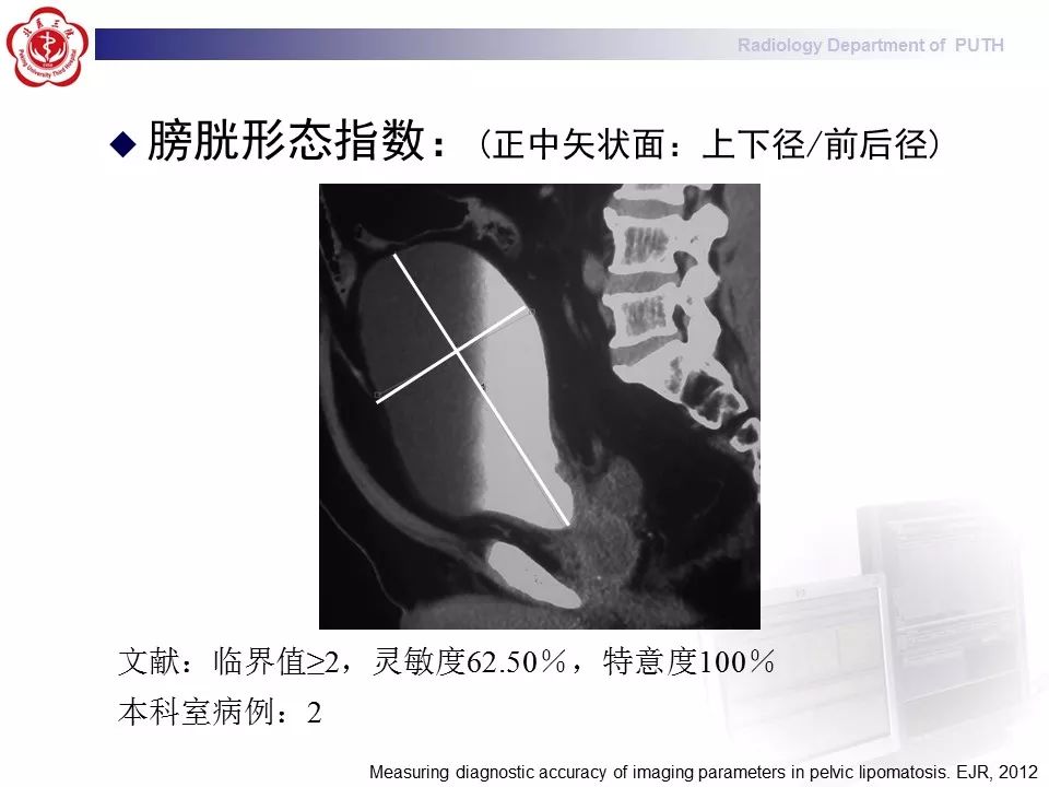 【病例】盆腔脂肪增多症1例CT影像表现