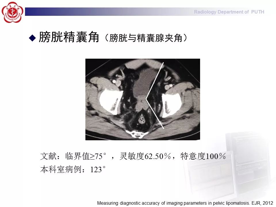 【病例】盆腔脂肪增多症1例CT影像表现