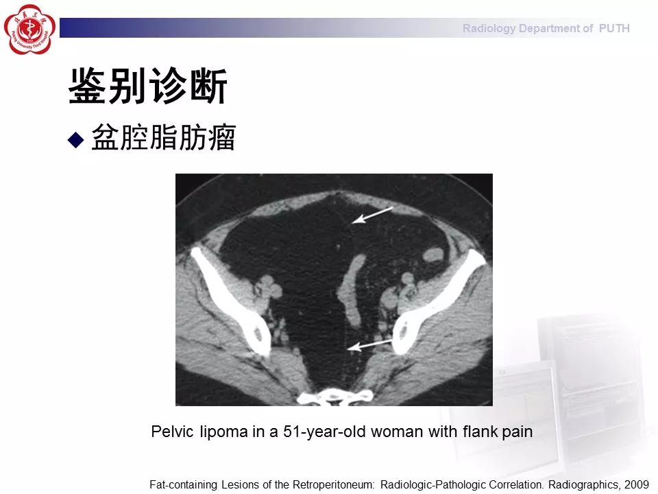 【病例】盆腔脂肪增多症1例CT影像表现