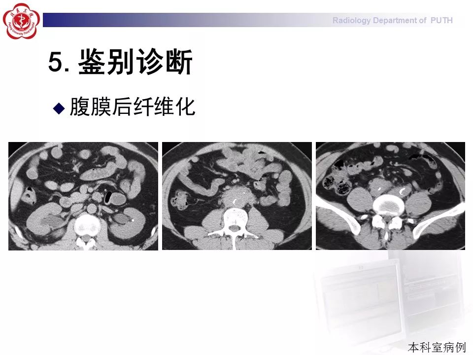 【病例】盆腔脂肪增多症1例CT影像表现