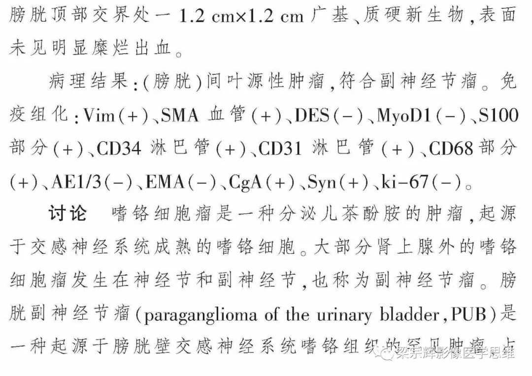 【病例】膀胱副神经节瘤1例CT影像表现