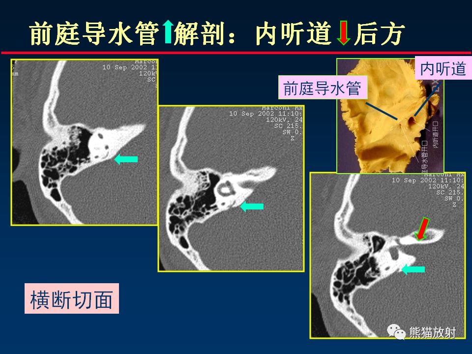 【PPT】颅底重要CT解剖及其临床意义