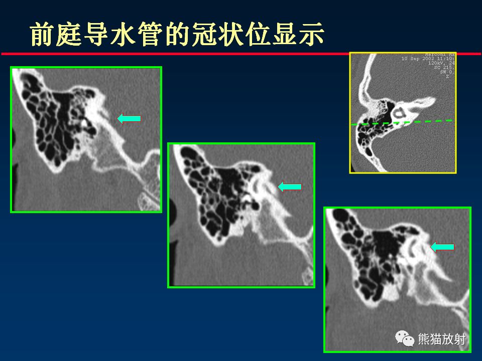 【PPT】颅底重要CT解剖及其临床意义