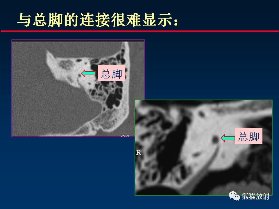 【PPT】颅底重要CT解剖及其临床意义