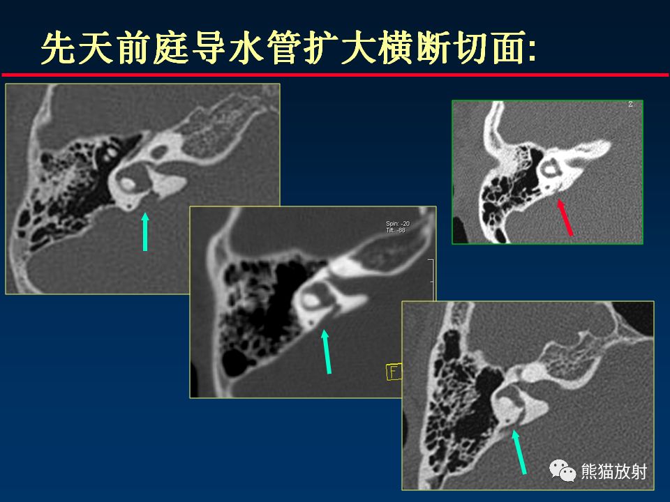 【PPT】颅底重要CT解剖及其临床意义
