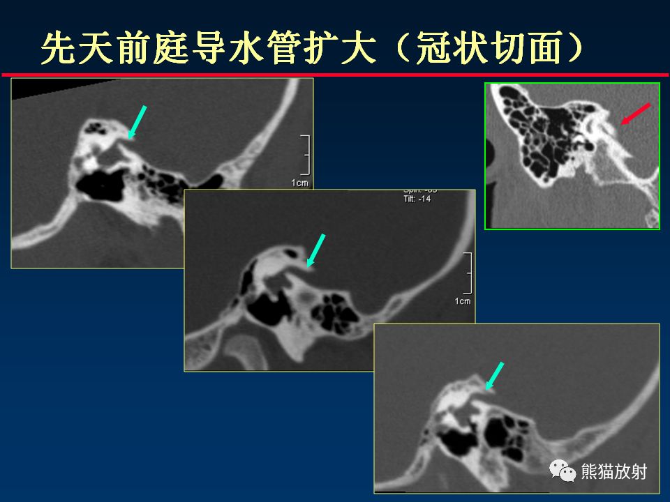 【PPT】颅底重要CT解剖及其临床意义