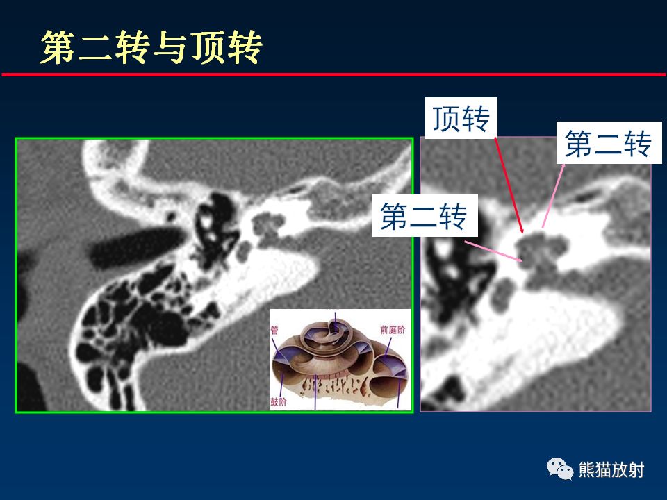 【PPT】颅底重要CT解剖及其临床意义
