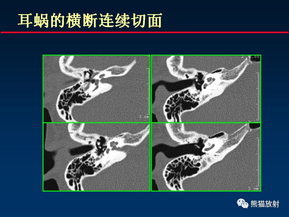 【PPT】颅底重要CT解剖及其临床意义